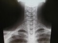 胸郭出口症候群の症状・原因・治療・手術・リハビリ