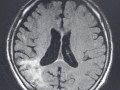理学療法士（PT）国試　脳血管障害の問題傾向