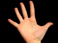 手指脱臼の症状・原因・治療