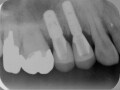 歯科インプラントの寿命と保証制度