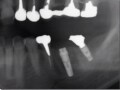 隣にインプラントがある場合の歯科治療の注意点