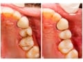 一生懸命歯磨きしても歯周病が進行するワケとは？　