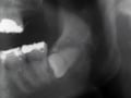 親知らずと歯科インプラントの関連性