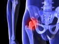 大腿骨頭壊死症の症状・診断・治療