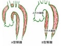 C-C-Bの渡辺英樹さんを襲った「大動脈解離」とは？