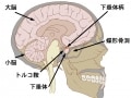 頭蓋咽頭腫の症状・診断・治療