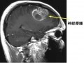 神経膠腫の症状・診断・治療