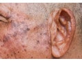 【症例画像】顔のイボ・老人性イボ「脂漏性角化症」の治療・予防法