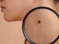 「ほくろを取ると、がんになる」って本当？ 母斑と悪性黒色腫の違い・セルフチェックのポイント