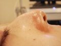 毛穴汚れ一掃！水のエステで顔面デトックス