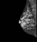 マンモグラフィーで乳がん検査