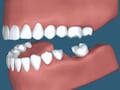 咬み合わせ調整…なぜ健康な歯も削るの？