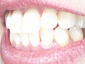 歯の「ツルツル」鏡面前歯の落とし穴！