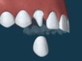 歯の被せ物……歯を削ってから被せるワケ