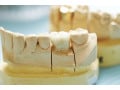 セラミックの歯が欠けた場合、修理はできるのか