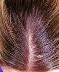 毛髪ミネラル検査は不妊治療にも有効か