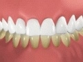歯のホワイトニングのウソ？ホント！