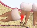 親知らずの治療・抜歯のリスクと注意点