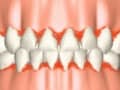 歯肉炎の予防・治療