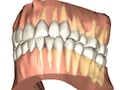 歯周病の症状と進行度