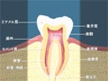 虫歯の原因・メカニズム