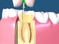 歯の神経を抜く方法・取り方とは？【歯科医が画像で解説】