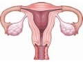 子宮脱の診断法・予防法・治療法