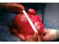 子宮筋腫の手術療法