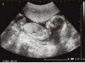 妊娠18週目エコー写真・赤ちゃんの大きさ・胎動が分かる人も