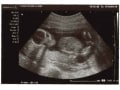 妊娠19週目 胎動や性別が分かる人も！胎児のエコー写真・大きさ