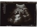 妊娠26週目エコー写真で見る胎児の体重と大きさ・早産になったら