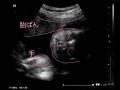 妊娠31週 胎児の体重や大きさをエコー写真で確認・早産や逆子の心配