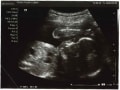 妊娠32週目 逆子は治る？胎児の体重や大きさをエコー写真で確認
