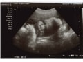 妊娠34週 胎児の大きさや体重をエコー写真で確認・逆子は治る？