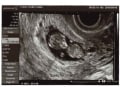 妊娠10週目 エコー写真や胎児の大きさ・10週の壁?!流産原因や症状