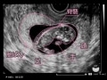 妊娠11週目エコー写真や胎児の大きさ平均・流産原因や症状