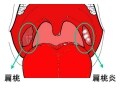 扁桃炎の症状・原因・治療