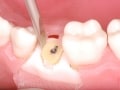 歯科インプラント治療は抜歯から