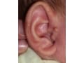 耳のできもの？ 新生児～大人の副耳とは……切除手術