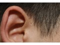 耳瘻孔・先天性耳瘻孔とは……腫れ・臭いがあれば手術も【画像あり】