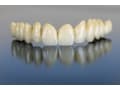 歯のかぶせものの種類・素材別の特徴