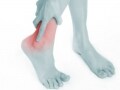 足関節骨折の症状・診断・治療