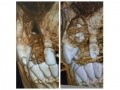 ベニアグラフト…インプラントの為の骨造成・骨移植術