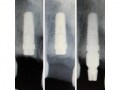 歯科インプラント手術後　歯槽骨の変化