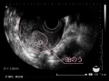妊娠4週目のエコー写真・胎芽や胎嚢・初期症状や流産のこと