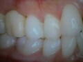 インプラント治療…上部構造完成までの仮歯の役割