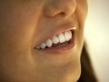 歯肉整形とは……審美性をさらに高める治療法