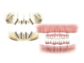 総義歯からのインプラント「オールオン4」とは