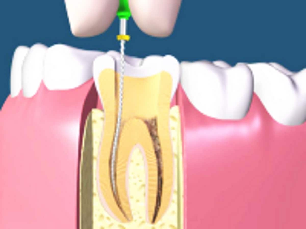歯 の 神経 を 抜く 方法