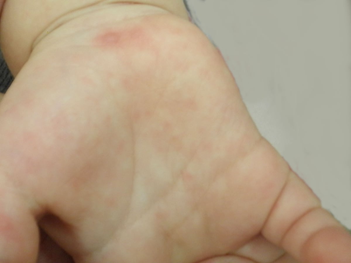 手足口和湿疹初期图片-图库-五毛网